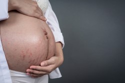Pregnancy Stretch Marks – How to deal with them?