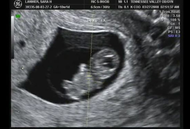 7-week-fetus