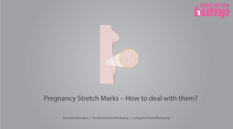 Pregnancy Stretch Marks