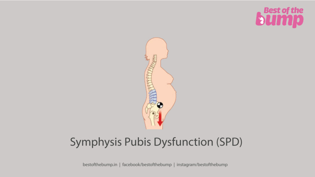 Symphysis Pubis Dysfunction (SPD)