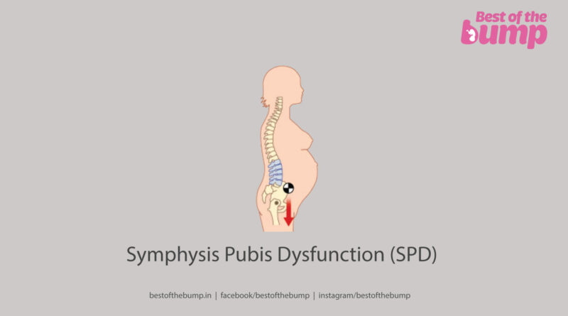 Symphysis Pubis Dysfunction