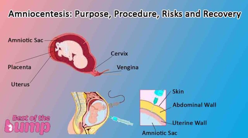Amniocentesis: Purpose, Procedure, Risks and Recovery