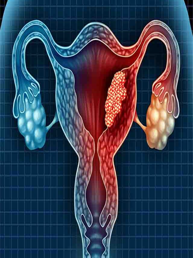 Choriocarcinoma During Pregnancy